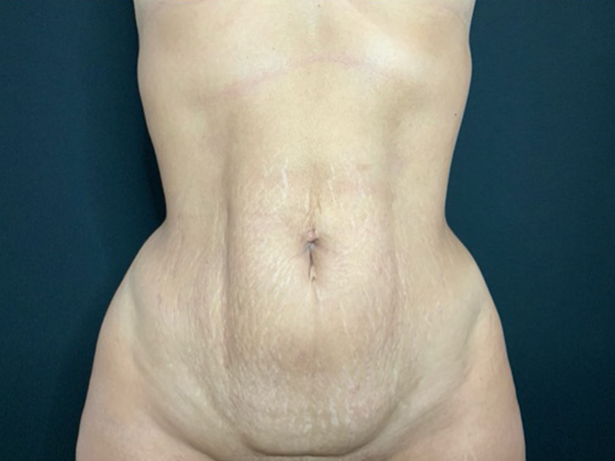 Case--2699 | Before Tummy Tuck