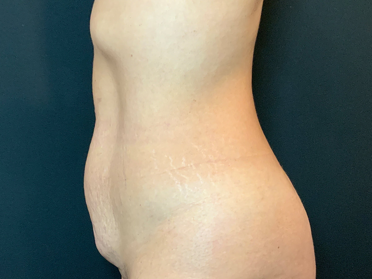 Case--2699 | Before Tummy Tuck 2