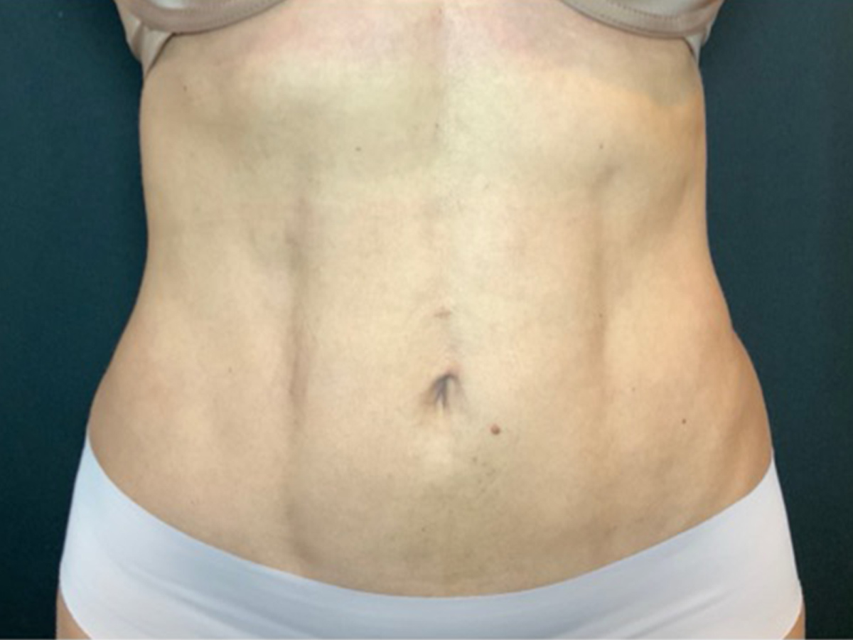 Case--1706 | After Liposuction