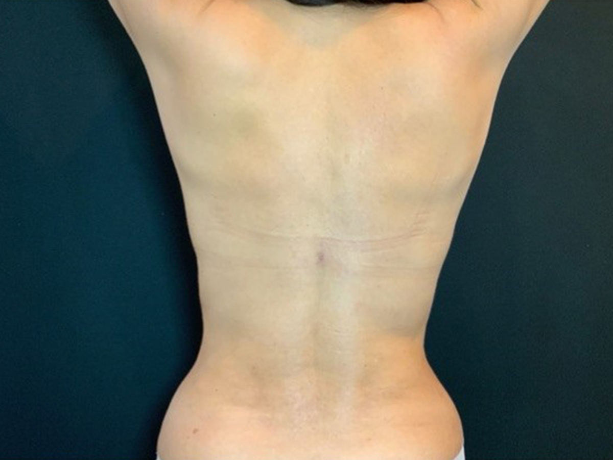 Case--1706 | After Liposuction 2