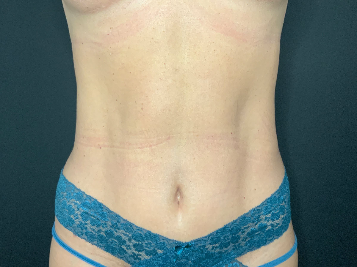 Case--2815 | After Tummy Tuck