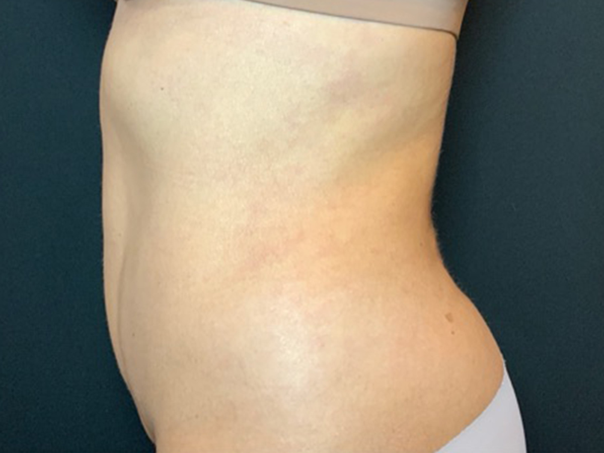 Case--1706 | After Liposuction 3