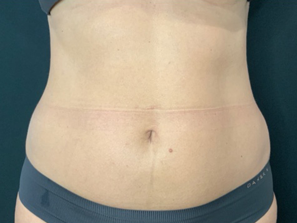 Case--1706 | Before Liposuction