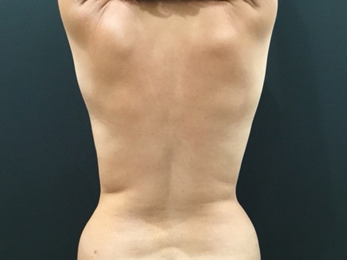 Case--1706 | Before Liposuction 2