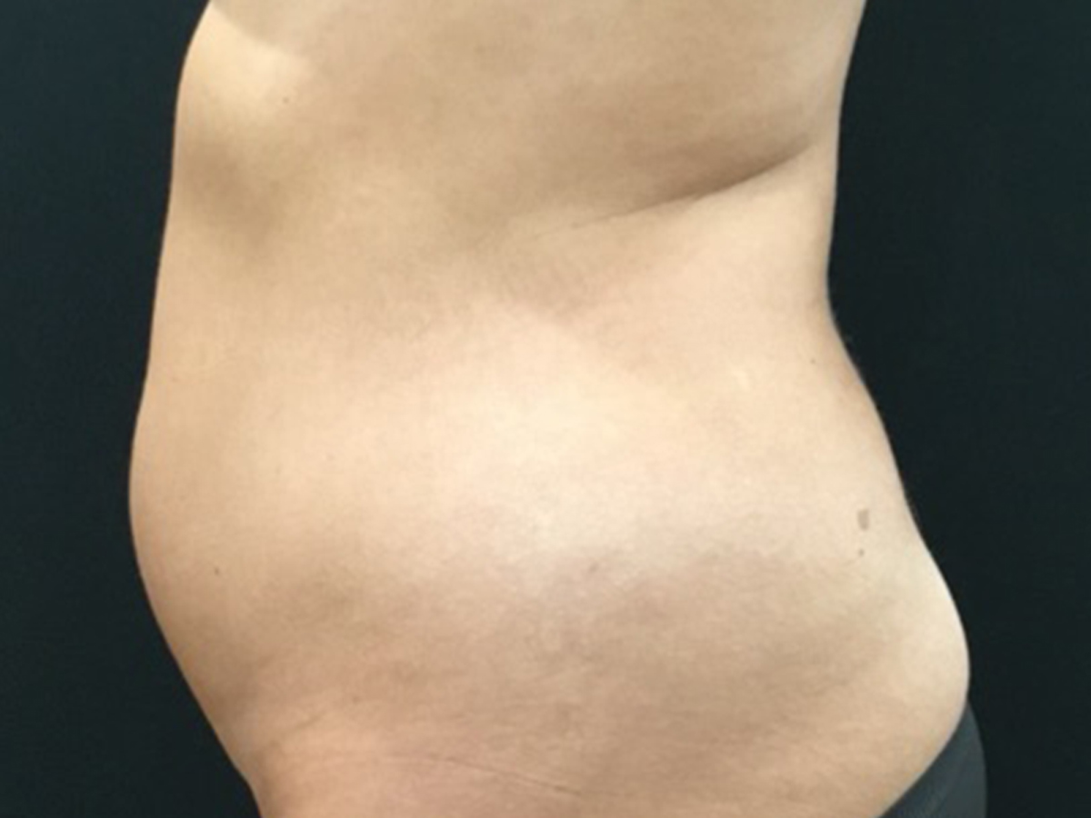 Case--1706 | Before Liposuction 3